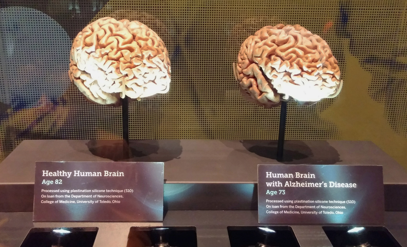 BRAIN: The Inside Story - healthy brain vs. brain with Alzheimer's