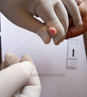 finger blood for bllod smear