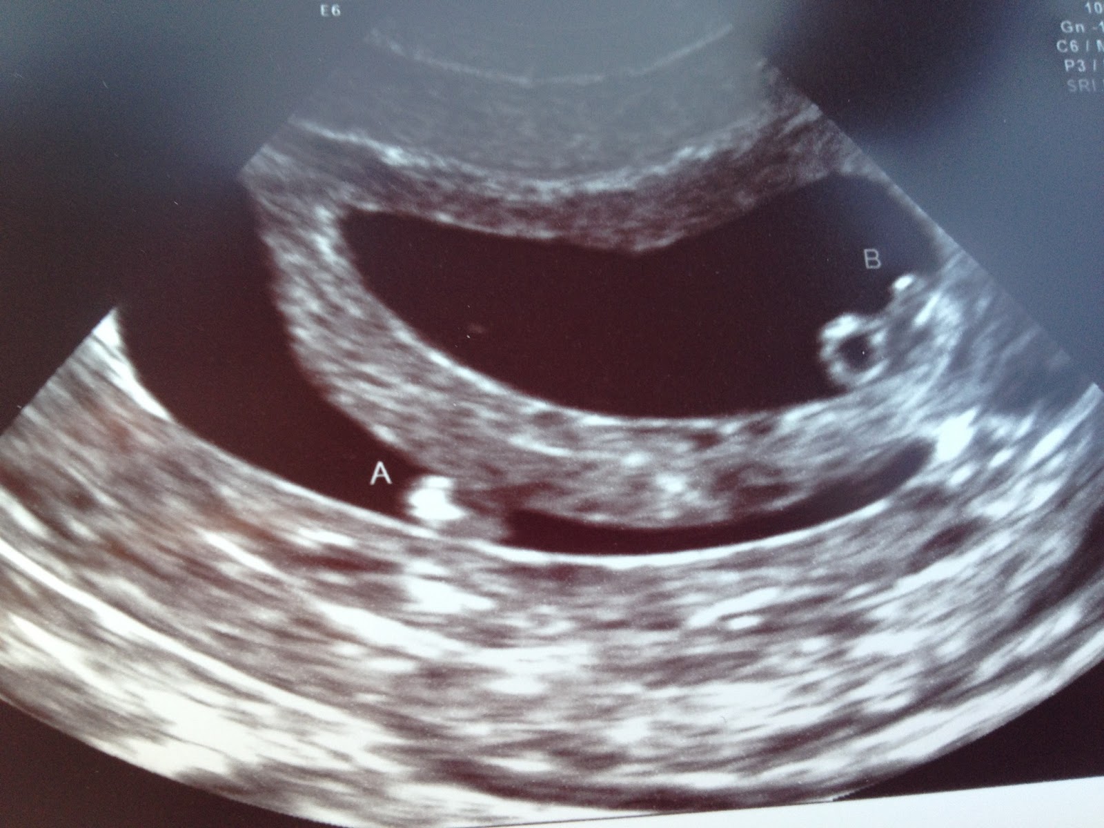 Twin Parenting 6 1/2 week twin belly