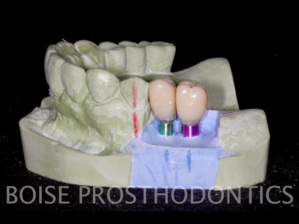 Boise Idaho Prosthodontics Posterior Provisional Zimmer Implant