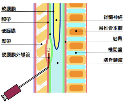 要不要打無痛