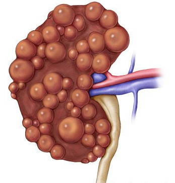 Kidney Disease und hoher Kreatinin: Polyzystische Nierenerkrankung: Welche Behandlung wird ...