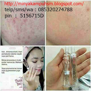 serum x'beino untuk menghilangkan jerawat