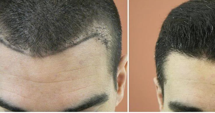 FUE - Is It A Better Alternative?