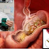 Eliminating NT and Helicobacter Pylori Bacteria Easily!