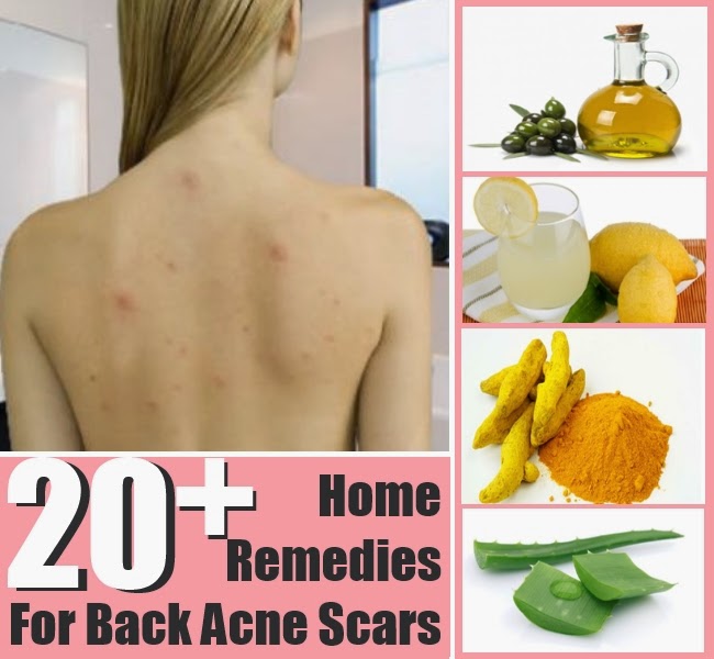 20+ Top Home Remedies for Back Acne Scars