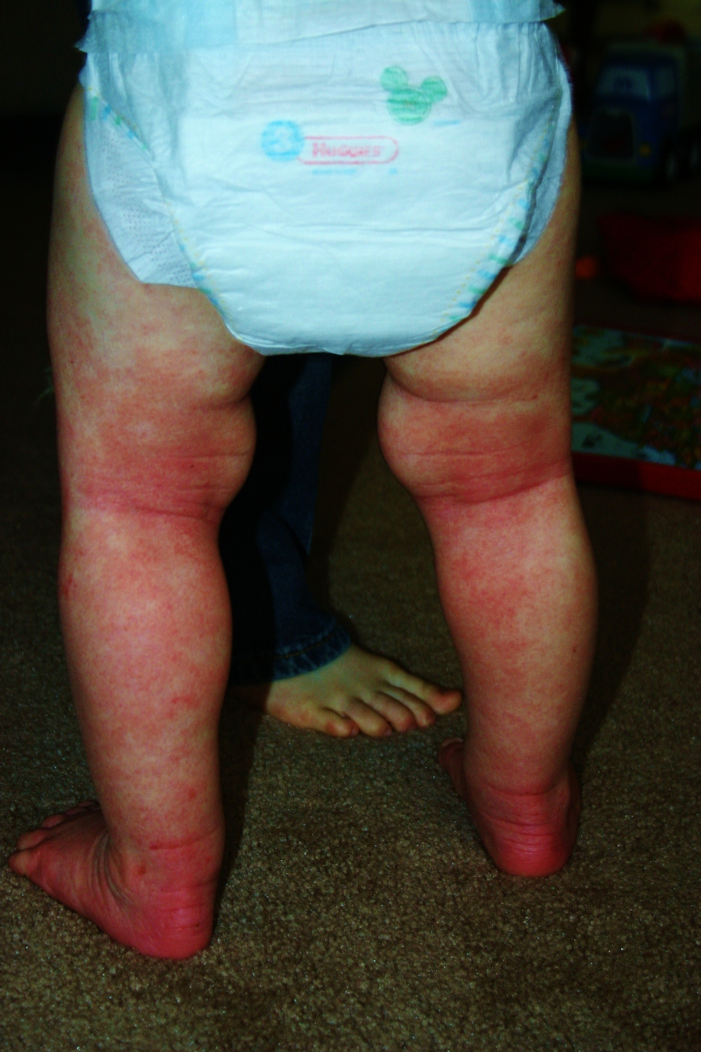 Sammy's Skin: Could it be... detergents?