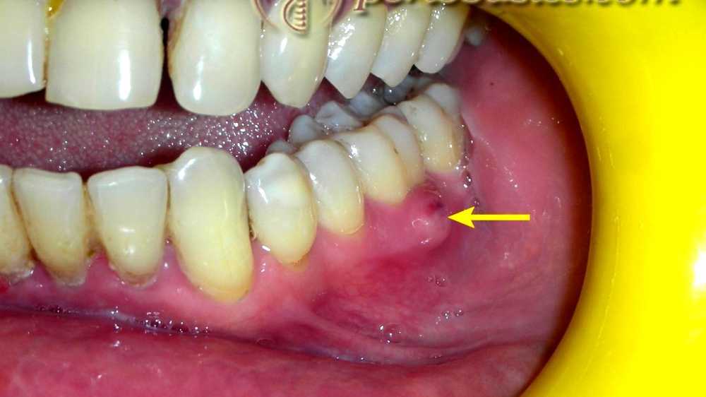 Periodontal abscess
