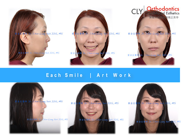 牙齒內傾！矯正後發生內傾！怎麼辦？