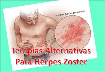 Terapias-Alternativas-Para-Herpes-Zoster-Culebrilla-Remedios-Caseros