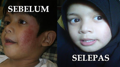 penawar-eczema
