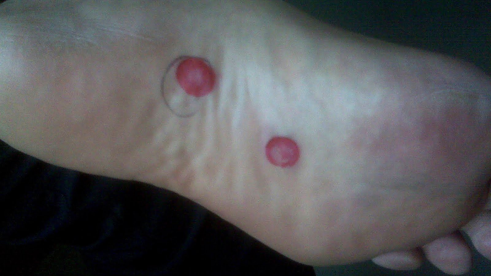 Can Plantar Fasciitis Cause Knee Pain Knee Choices