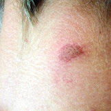 Early Stage Black Widow Spider Bite Symptoms : Hellowellness - Symptoms, stages, causes, pictures and treatment information.