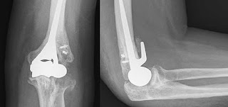 Best Hospital For Elbow Replacement Surgery In India