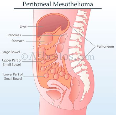 Peritoneal Mesothelioma Symptoms, Life Expectancy  Peritoneal Cancer Survival Rate, Prognosis 