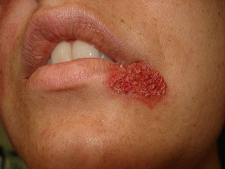 Herpes Oral o Herpes Labial 