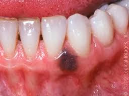 Oral Melanotic Macule in Adults: Condition, Treatments ...