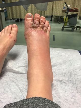After A Beach Vacation, This Couple Returned Home In Pain With Worms In Their Feet