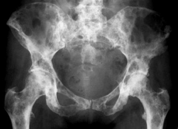 What is Metastatic Bone Disease? | El Paso, TX Chiropractor