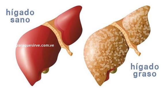 Como curar el hígado graso.