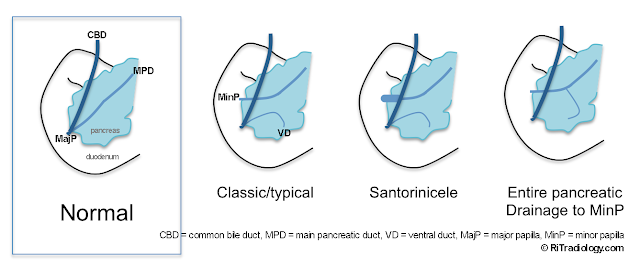 RiT radiology: Pancreatic Divisum