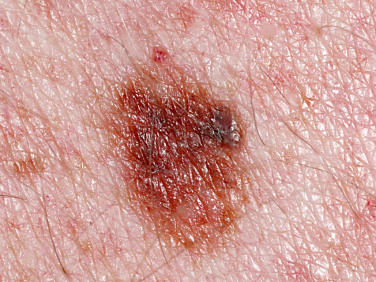Interesting Facts: Is it Skin Cancer? 38 Photos that could Save your Life
