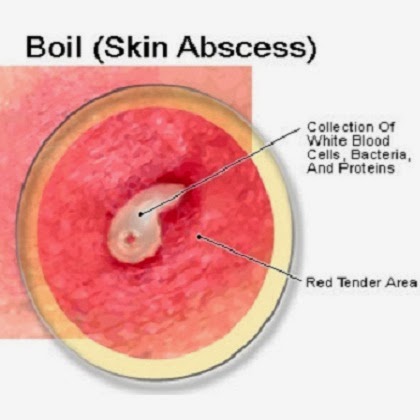 what causes boil on the skin