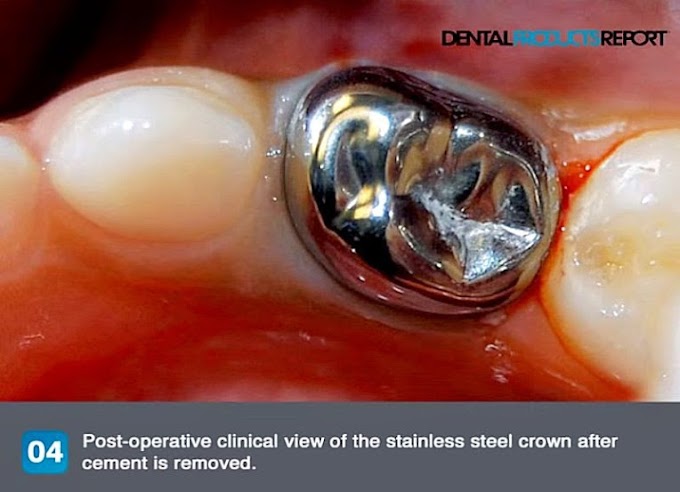 How to cement a Stainless Steel Crown Step by Step