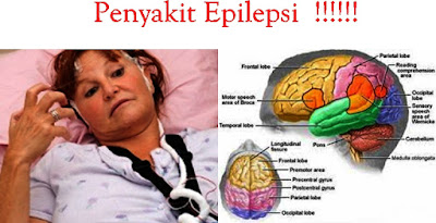penanganan epilepsi pada dewasa penanganan epilepsi pada dewasa