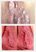 Obat Ampuh Sembuhkan Kutil Yang Tumbuh Pada Vagina Obat Ampuh Sembuhkan Kutil Yang Tumbuh Pada Vagina