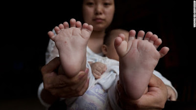 Baby born with 31 fingers and toes