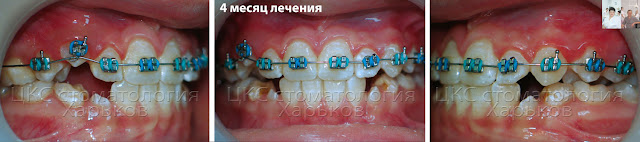 Лечение брекетами 4 месяц 4 месяц ортодонтического лечения