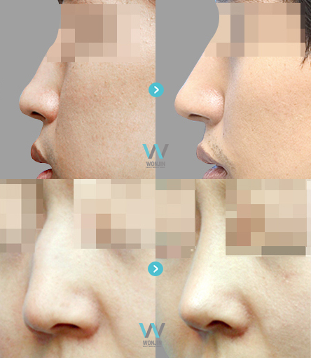 части лица в косметологии. точечный массаж при насморке и заложенности носа. филлеры в лицо зоны. точечный массаж гайморит фронтит. гайморит этмоидит сфеноидит.