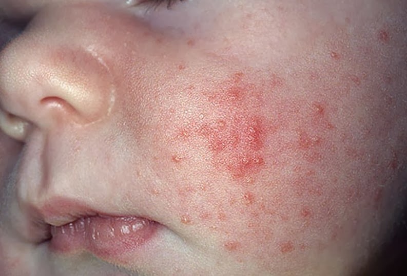 skin rash on face