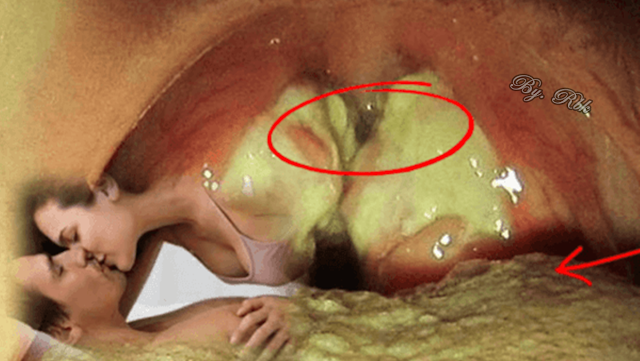papiloma humano se puede contagiar por besos