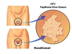 cara mengatsi kutil kelamin