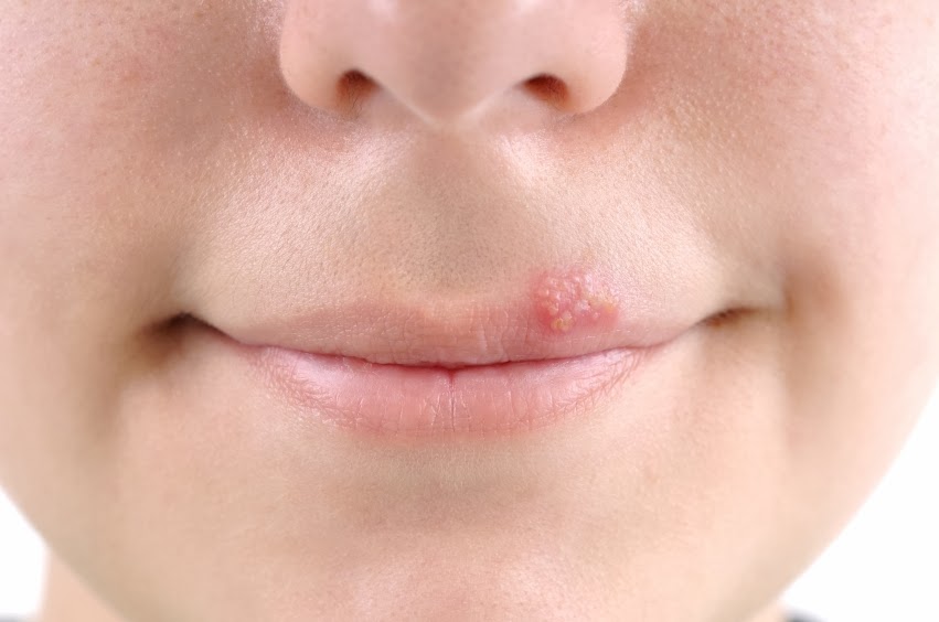 Ask Dr. Lily Talakoub: Cold Sore Season: Know Your Treatment Options