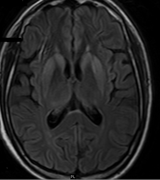 CreutzfeldtJacob disease Teaching Points Sumer's Radiology Blog