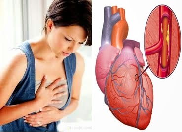 Obat Jantung Rematik Tanpa Operasi