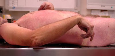 As diferentes fases do corpo humano após a morte Post Mortem, Livor Mortis, Cadáver, hipostase cadavérica