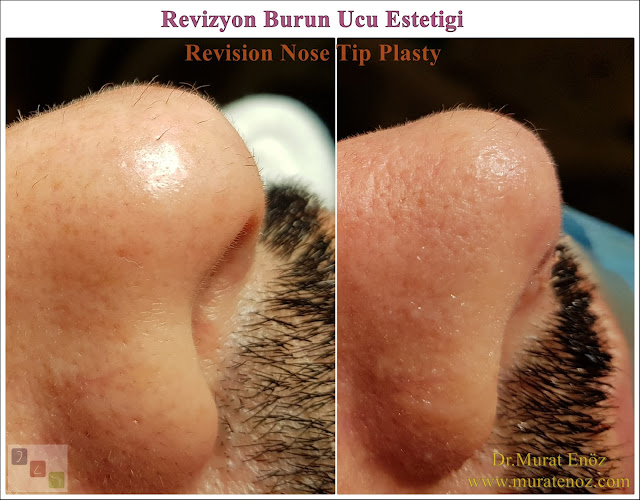 Revision nose tip plasty? - Revision nose tip surgery - Revision nose tip plasty in Istanbul - Revision nose tip plasty in men Istanbul