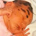 Ce bébé est né avec des taches de naissance sur tout le corps, maintenant voyez la 19 ans plus tard!