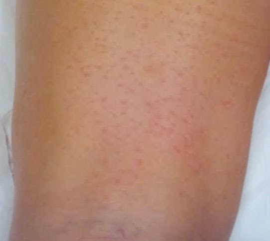 hives from waxing