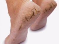 Cara Mudah Dan Efektif Mengatasi Kaki Pecah Pecah Cara Mudah Dan Efektif Mengatasi Kaki Pecah Pecah