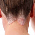 Trị nấm da đầu hiệu quả bằng cách nào?