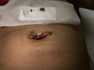 Incision uncovered for the 2nd time – just before removing all the remaining clip