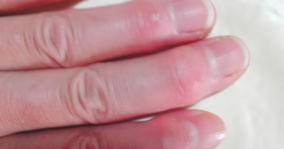 へバーデン結節『ミューカシスト(粘液嚢腫)』の痛み