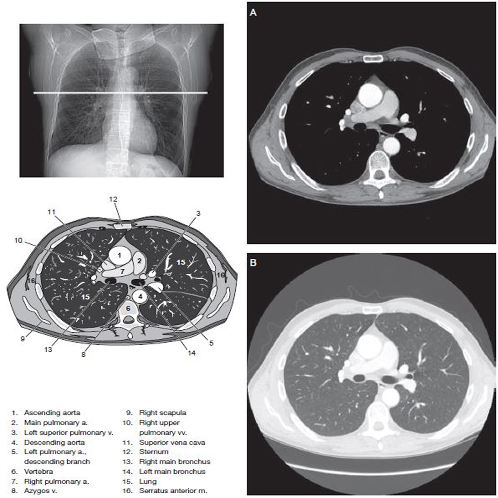 Chest CT Scan Imaging - RadTechOnDuty