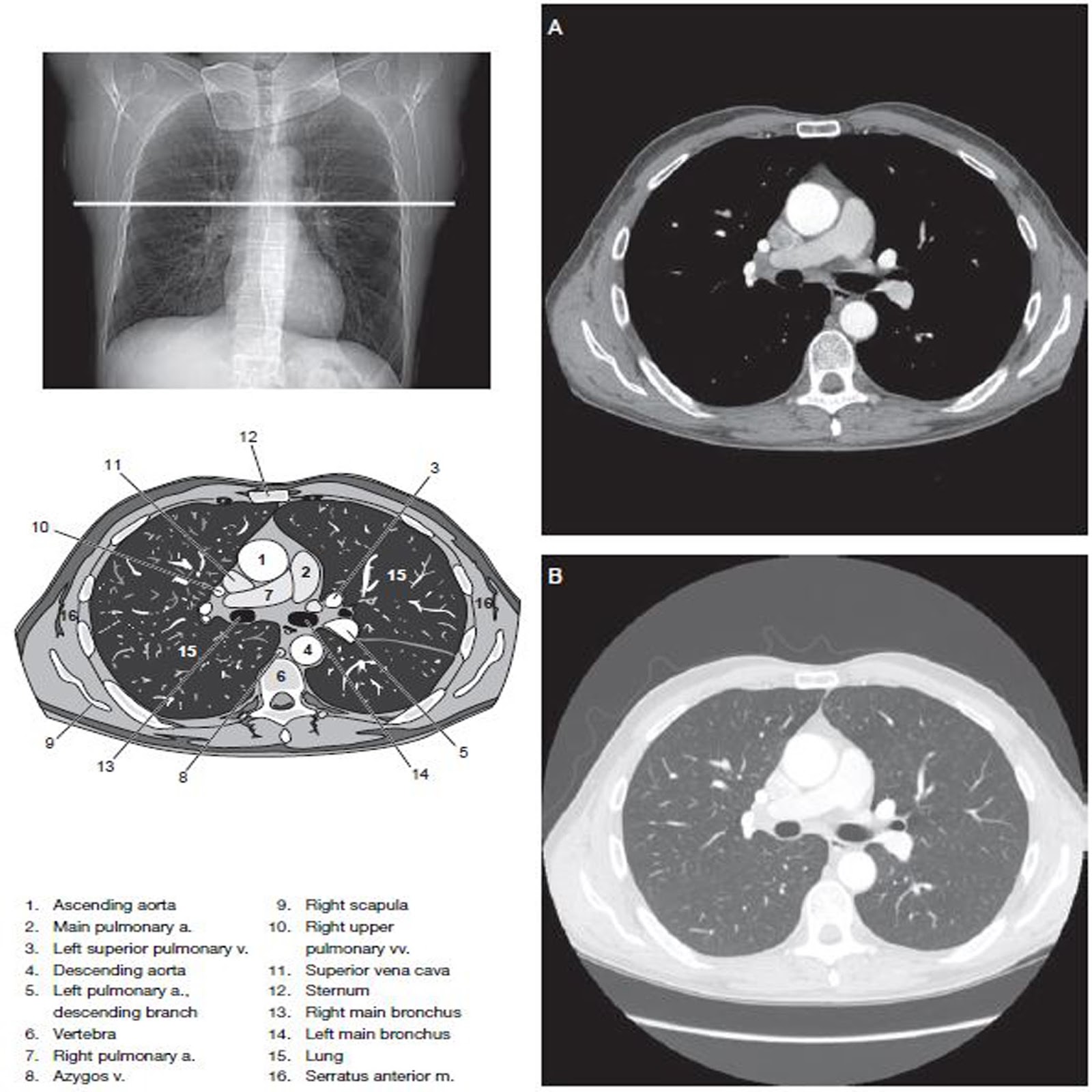 Chest Ct Scan Imaging Radtechonduty