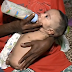 No Ceará, bebê nasce sem braços e sem pernas